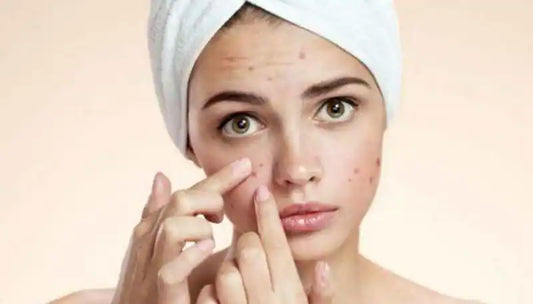 5 Things not to do when you have acne